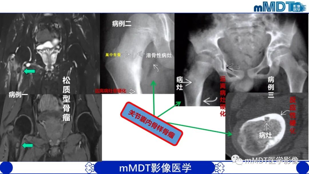 mmd在医学上什么意思髋关节疼痛影像与临床（二）--王勇老师公开课_https://www.jmylbn.com_新闻资讯_第32张