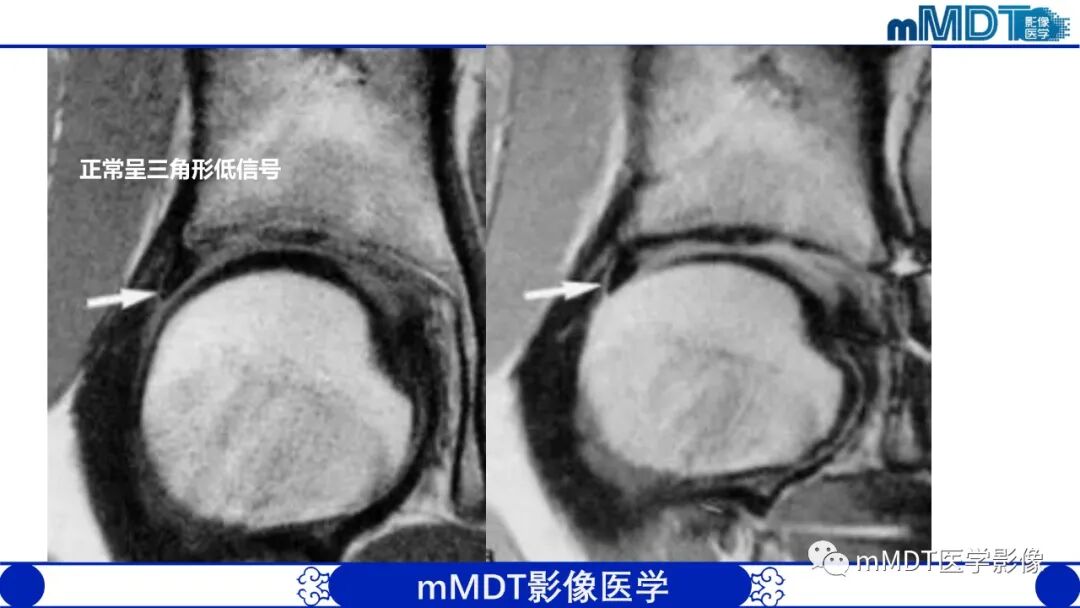 mmd在医学上什么意思髋关节疼痛影像与临床（二）--王勇老师公开课_https://www.jmylbn.com_新闻资讯_第24张