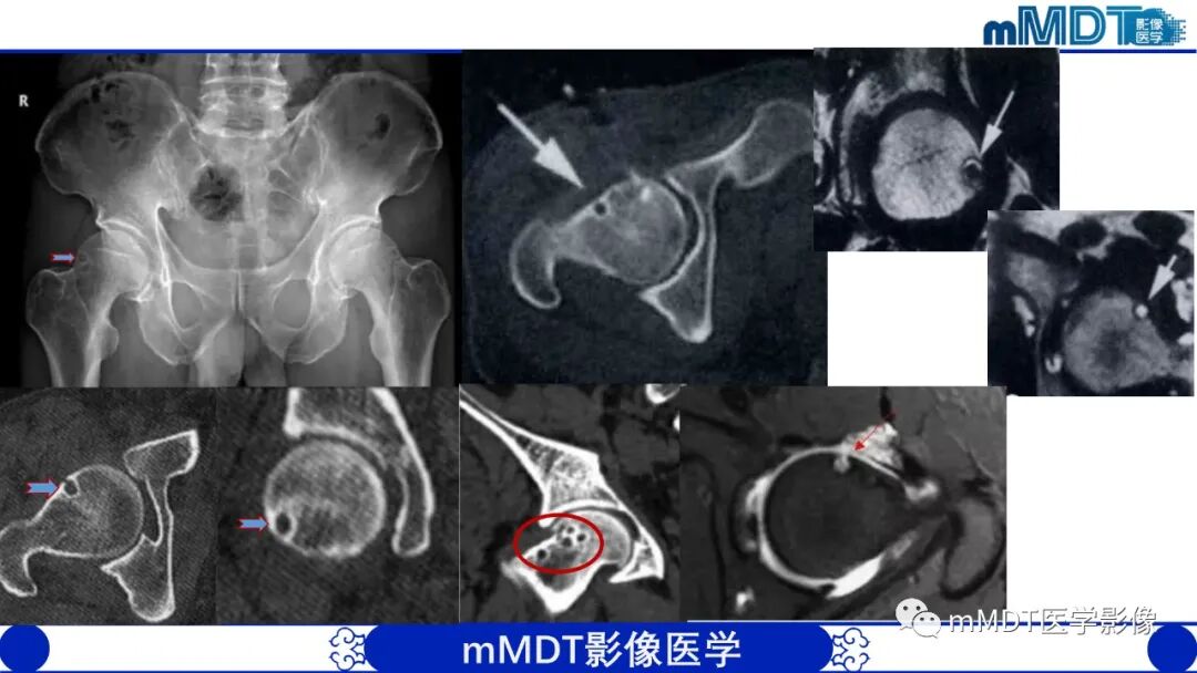 mmd在医学上什么意思髋关节疼痛影像与临床（二）--王勇老师公开课_https://www.jmylbn.com_新闻资讯_第45张