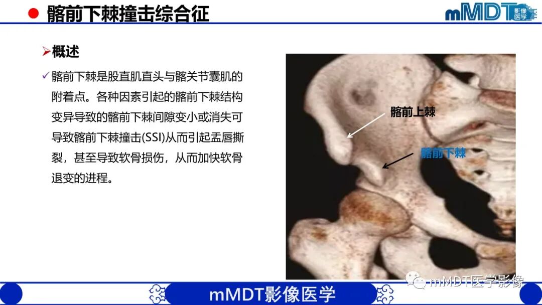 mmd在医学上什么意思髋关节疼痛影像与临床（二）--王勇老师公开课_https://www.jmylbn.com_新闻资讯_第9张