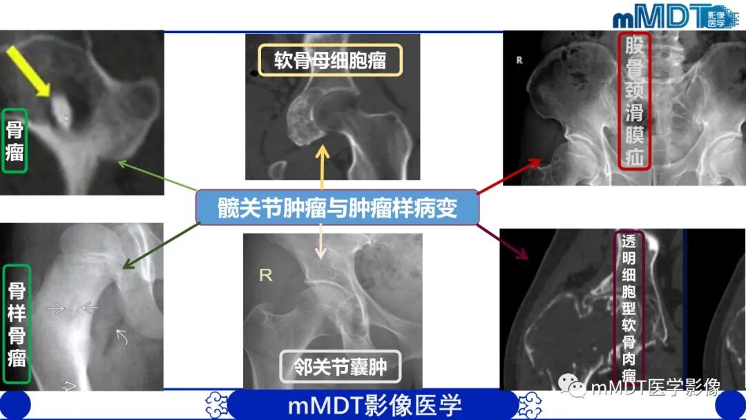 mmd在医学上什么意思髋关节疼痛影像与临床（二）--王勇老师公开课_https://www.jmylbn.com_新闻资讯_第47张