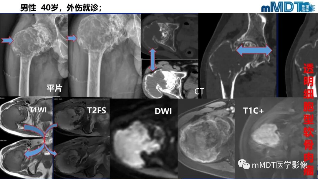mmd在医学上什么意思髋关节疼痛影像与临床（二）--王勇老师公开课_https://www.jmylbn.com_新闻资讯_第38张