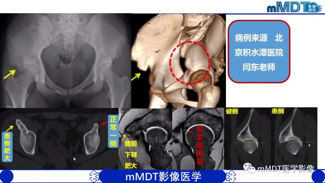 mmd在医学上什么意思髋关节疼痛影像与临床（二）--王勇老师公开课_https://www.jmylbn.com_新闻资讯_第11张