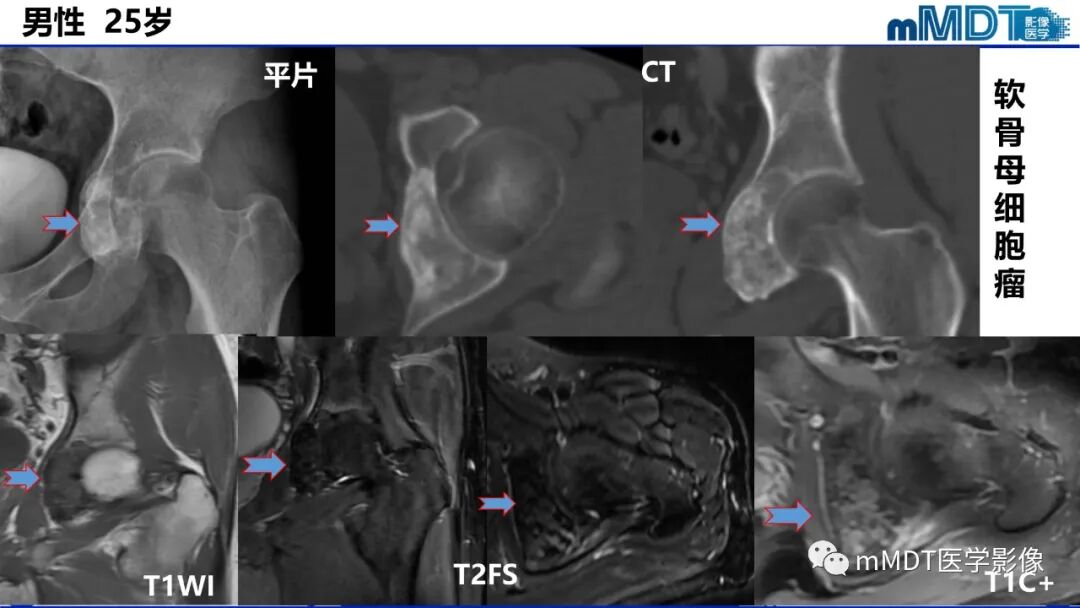 mmd在医学上什么意思髋关节疼痛影像与临床（二）--王勇老师公开课_https://www.jmylbn.com_新闻资讯_第35张