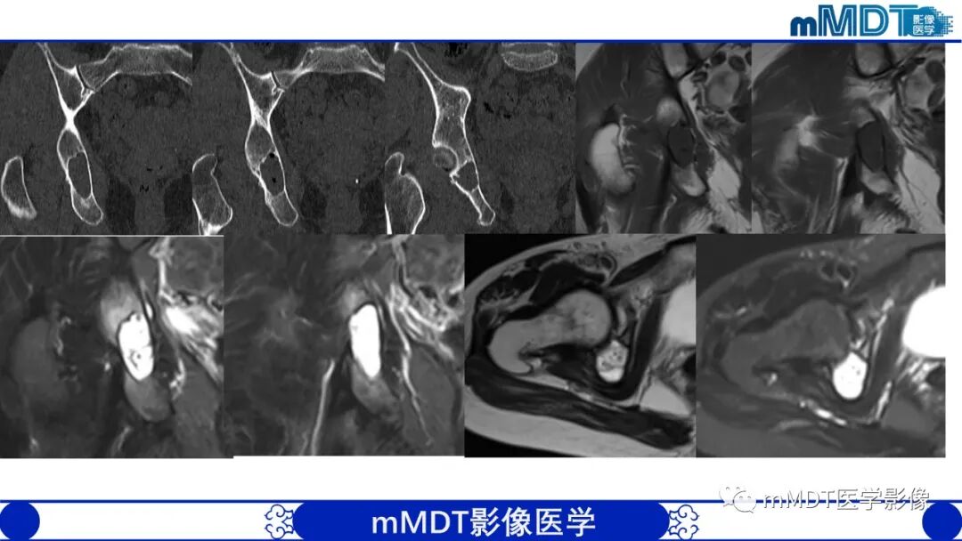 mmd在医学上什么意思髋关节疼痛影像与临床（二）--王勇老师公开课_https://www.jmylbn.com_新闻资讯_第43张