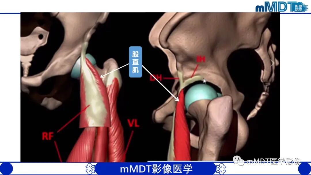 mmd在医学上什么意思髋关节疼痛影像与临床（二）--王勇老师公开课_https://www.jmylbn.com_新闻资讯_第10张