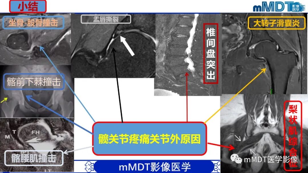 mmd在医学上什么意思髋关节疼痛影像与临床（二）--王勇老师公开课_https://www.jmylbn.com_新闻资讯_第46张