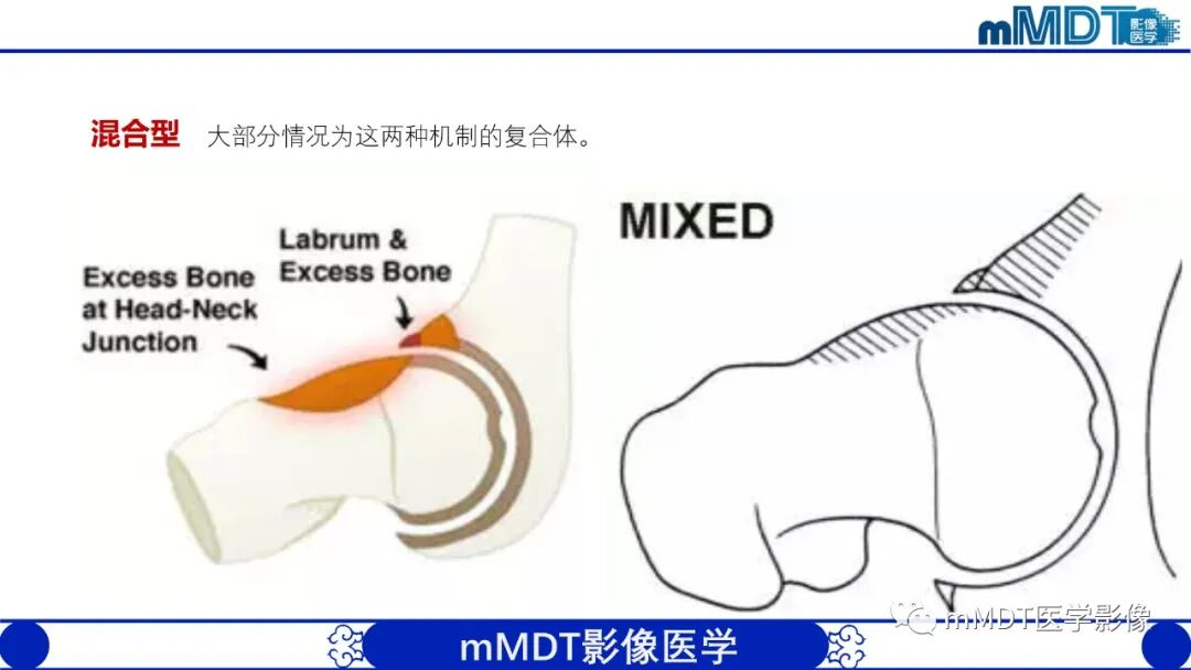 mmd在医学上什么意思髋关节疼痛临床与影像（一）_https://www.jmylbn.com_新闻资讯_第28张
