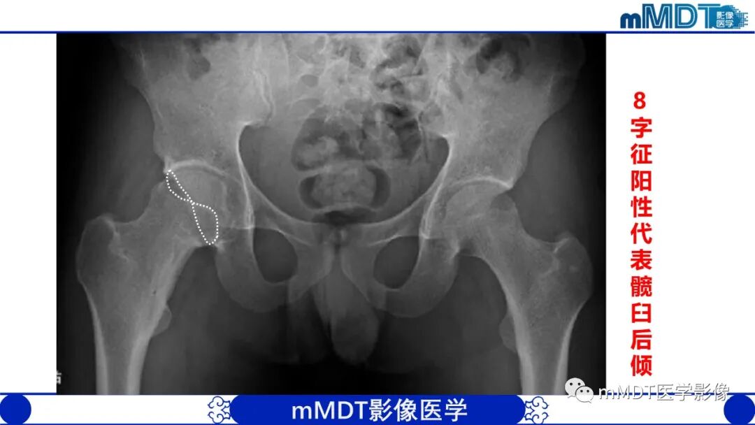 mmd在医学上什么意思髋关节疼痛临床与影像（一）_https://www.jmylbn.com_新闻资讯_第25张