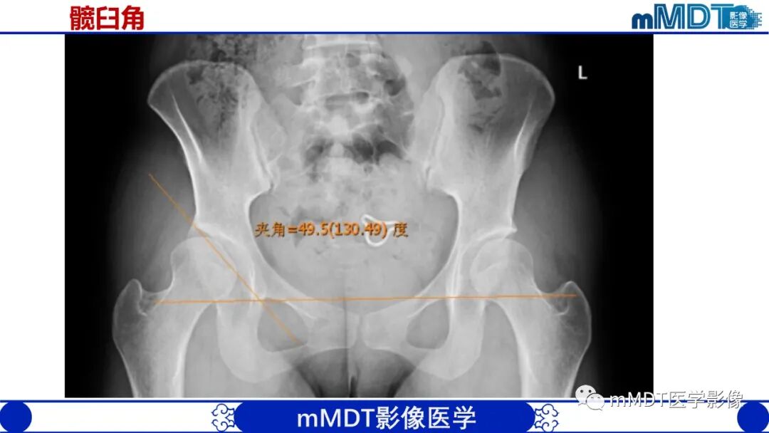mmd在医学上什么意思髋关节疼痛临床与影像（一）_https://www.jmylbn.com_新闻资讯_第12张