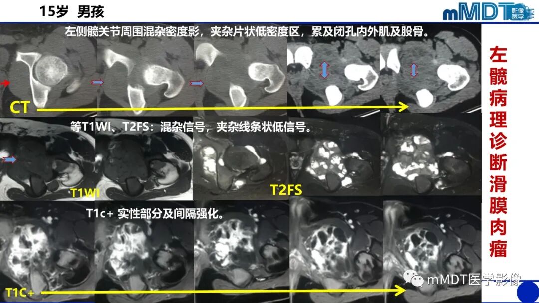 mmd在医学上什么意思髋关节疼痛临床与影像（一）_https://www.jmylbn.com_新闻资讯_第58张
