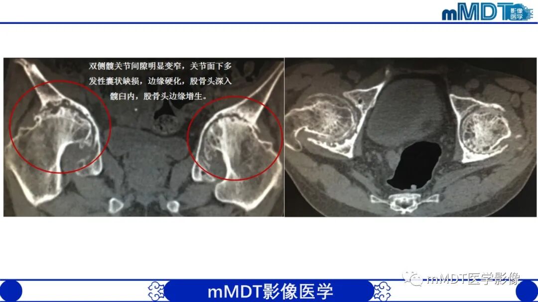 mmd在医学上什么意思髋关节疼痛临床与影像（一）_https://www.jmylbn.com_新闻资讯_第49张