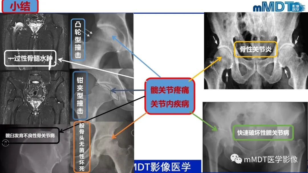 mmd在医学上什么意思髋关节疼痛临床与影像（一）_https://www.jmylbn.com_新闻资讯_第59张