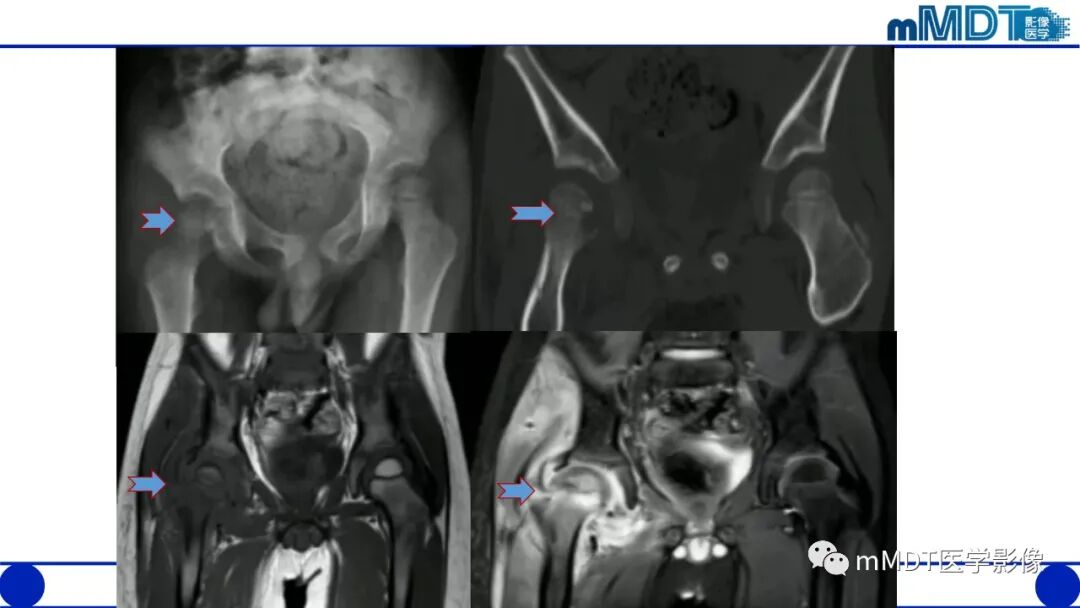 mmd在医学上什么意思髋关节疼痛临床与影像（一）_https://www.jmylbn.com_新闻资讯_第41张