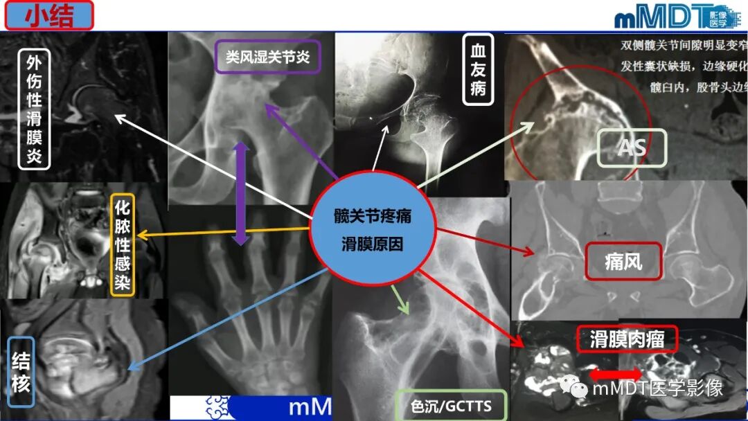 mmd在医学上什么意思髋关节疼痛临床与影像（一）_https://www.jmylbn.com_新闻资讯_第60张