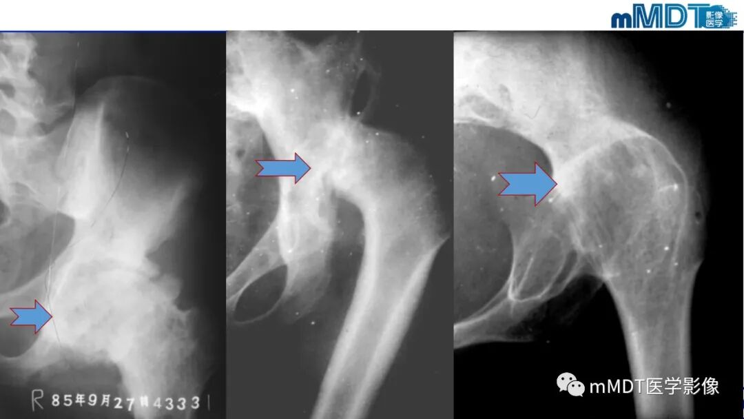 mmd在医学上什么意思髋关节疼痛临床与影像（一）_https://www.jmylbn.com_新闻资讯_第42张