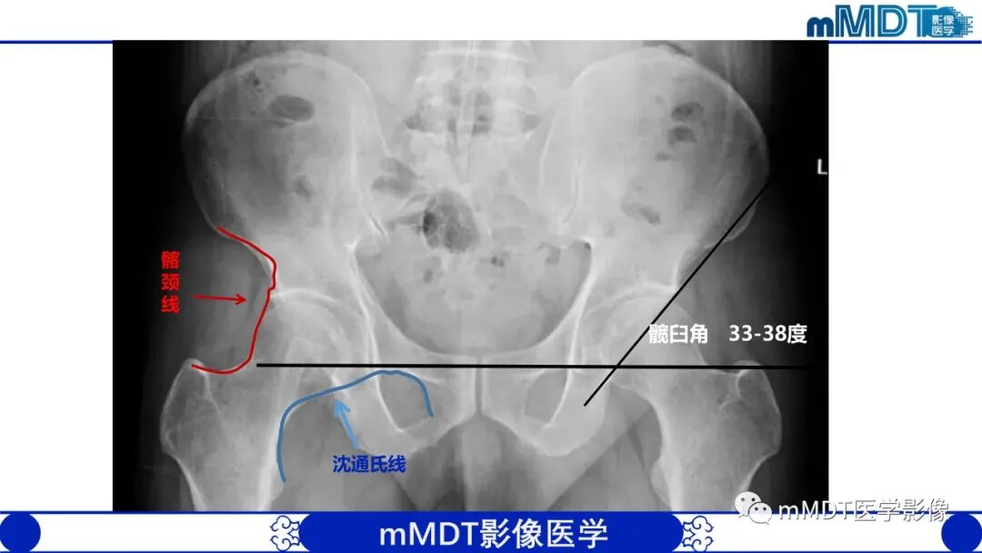 mmd在医学上什么意思髋关节疼痛临床与影像（一）_https://www.jmylbn.com_新闻资讯_第9张