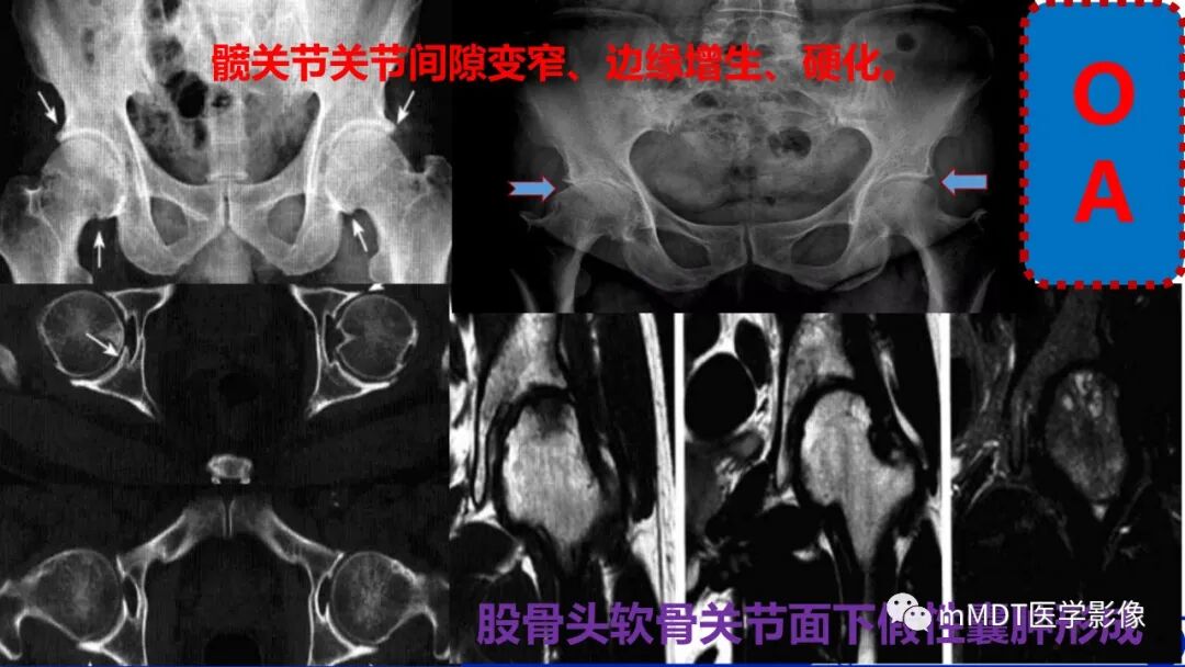 mmd在医学上什么意思髋关节疼痛临床与影像（一）_https://www.jmylbn.com_新闻资讯_第34张