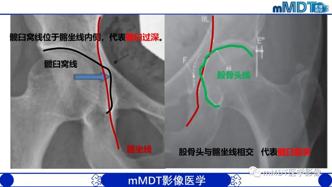 mmd在医学上什么意思髋关节疼痛临床与影像（一）_https://www.jmylbn.com_新闻资讯_第23张
