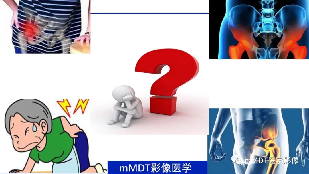 mmd在医学上什么意思髋关节疼痛临床与影像（一）_https://www.jmylbn.com_新闻资讯_第4张