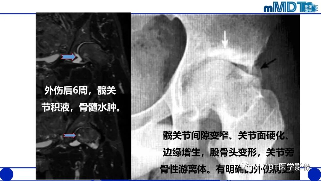 mmd在医学上什么意思髋关节疼痛临床与影像（一）_https://www.jmylbn.com_新闻资讯_第39张