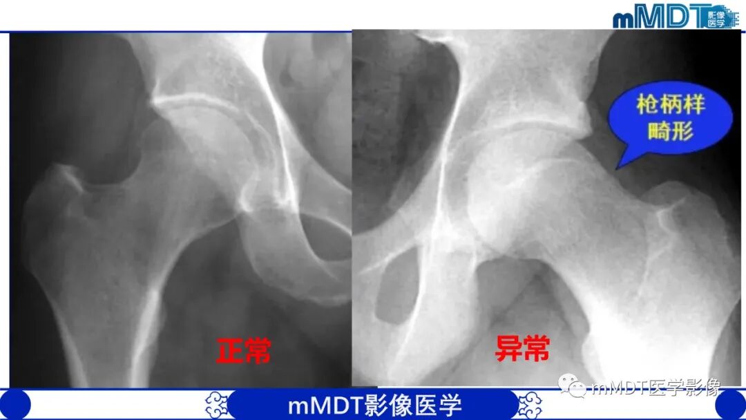 mmd在医学上什么意思髋关节疼痛临床与影像（一）_https://www.jmylbn.com_新闻资讯_第20张