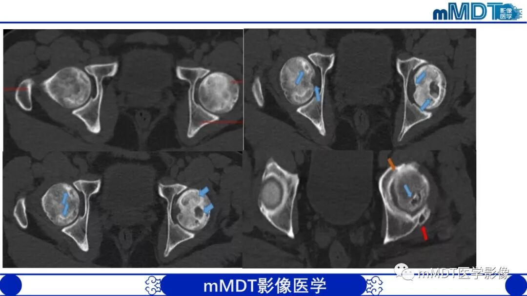 mmd在医学上什么意思髋关节疼痛临床与影像（一）_https://www.jmylbn.com_新闻资讯_第31张