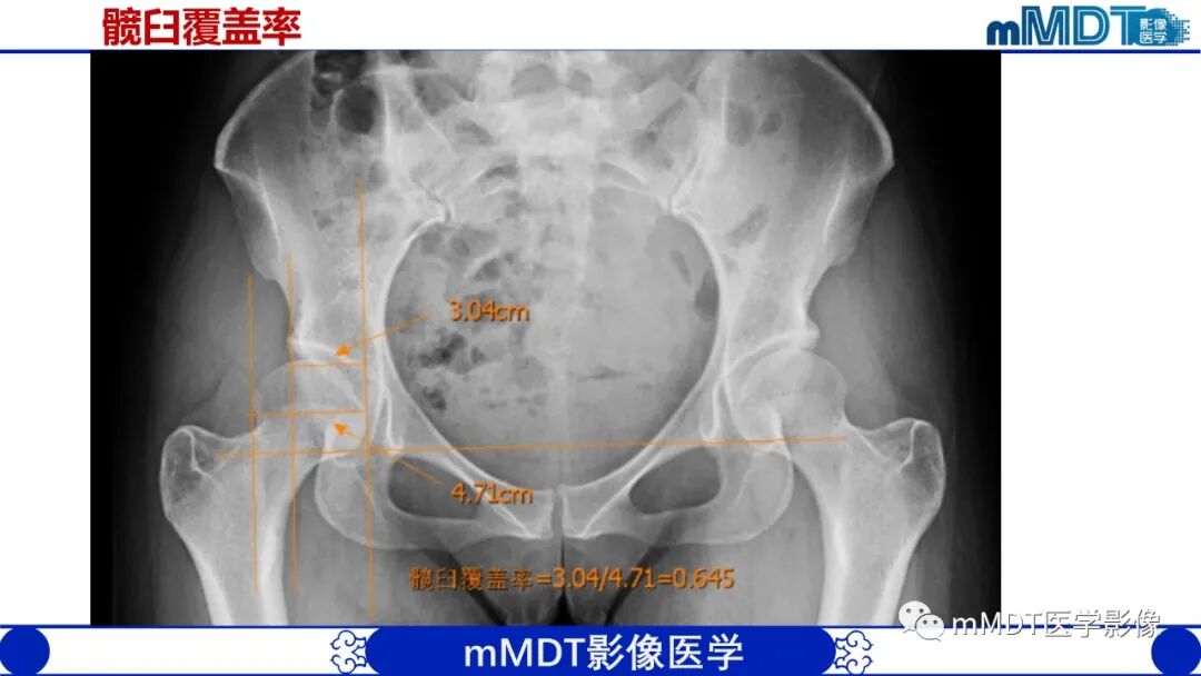 mmd在医学上什么意思髋关节疼痛临床与影像（一）_https://www.jmylbn.com_新闻资讯_第13张