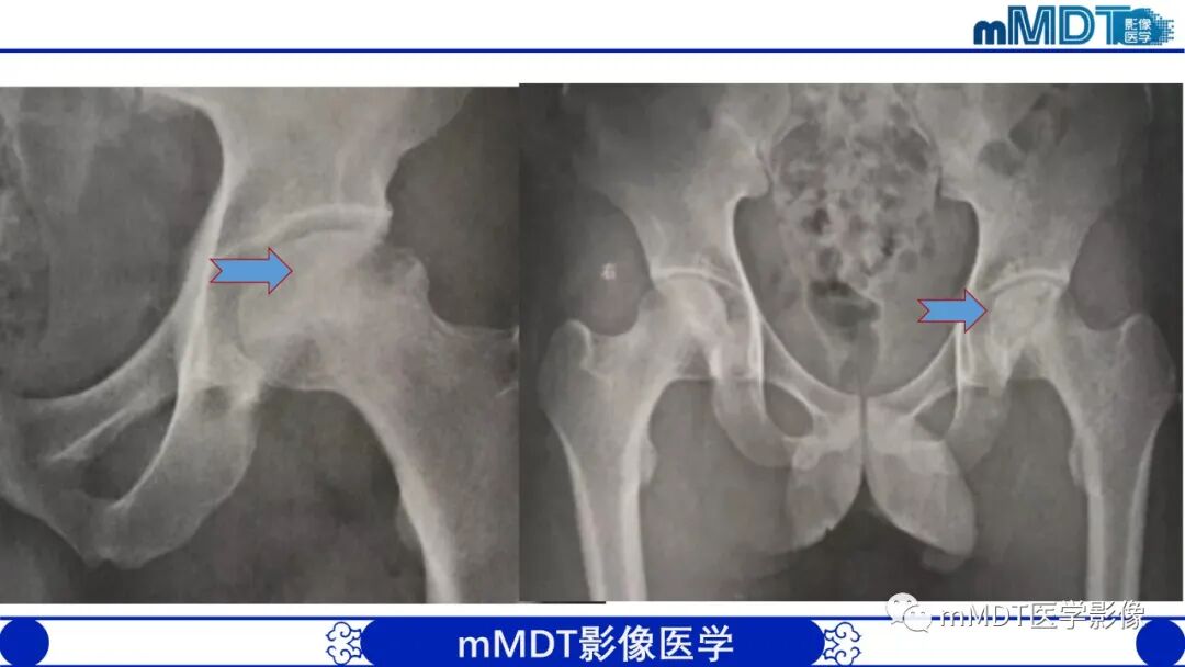 mmd在医学上什么意思髋关节疼痛临床与影像（一）_https://www.jmylbn.com_新闻资讯_第30张