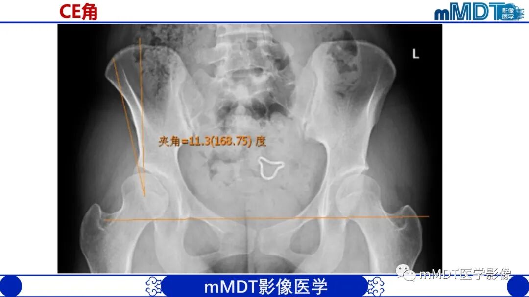 mmd在医学上什么意思髋关节疼痛临床与影像（一）_https://www.jmylbn.com_新闻资讯_第11张