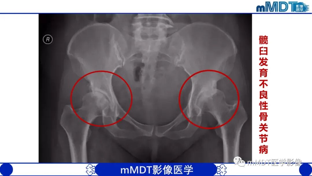 mmd在医学上什么意思髋关节疼痛临床与影像（一）_https://www.jmylbn.com_新闻资讯_第14张