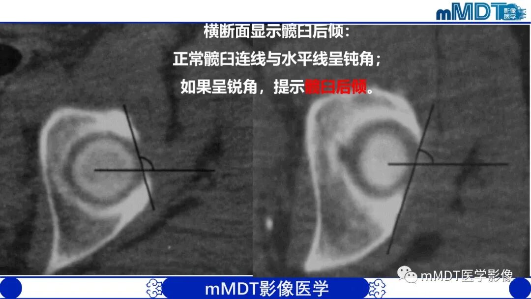 mmd在医学上什么意思髋关节疼痛临床与影像（一）_https://www.jmylbn.com_新闻资讯_第27张