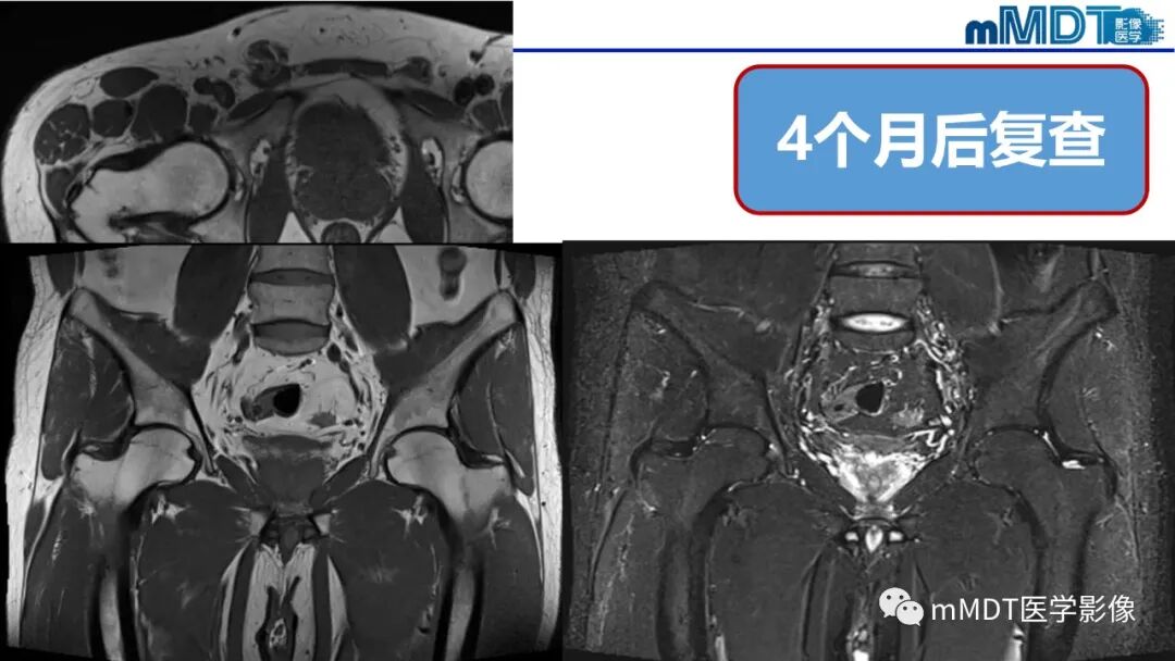 mmd在医学上什么意思髋关节疼痛临床与影像（一）_https://www.jmylbn.com_新闻资讯_第8张