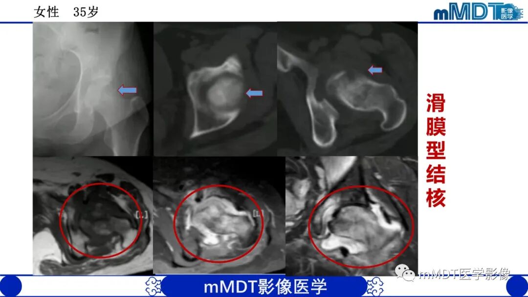 mmd在医学上什么意思髋关节疼痛临床与影像（一）_https://www.jmylbn.com_新闻资讯_第44张