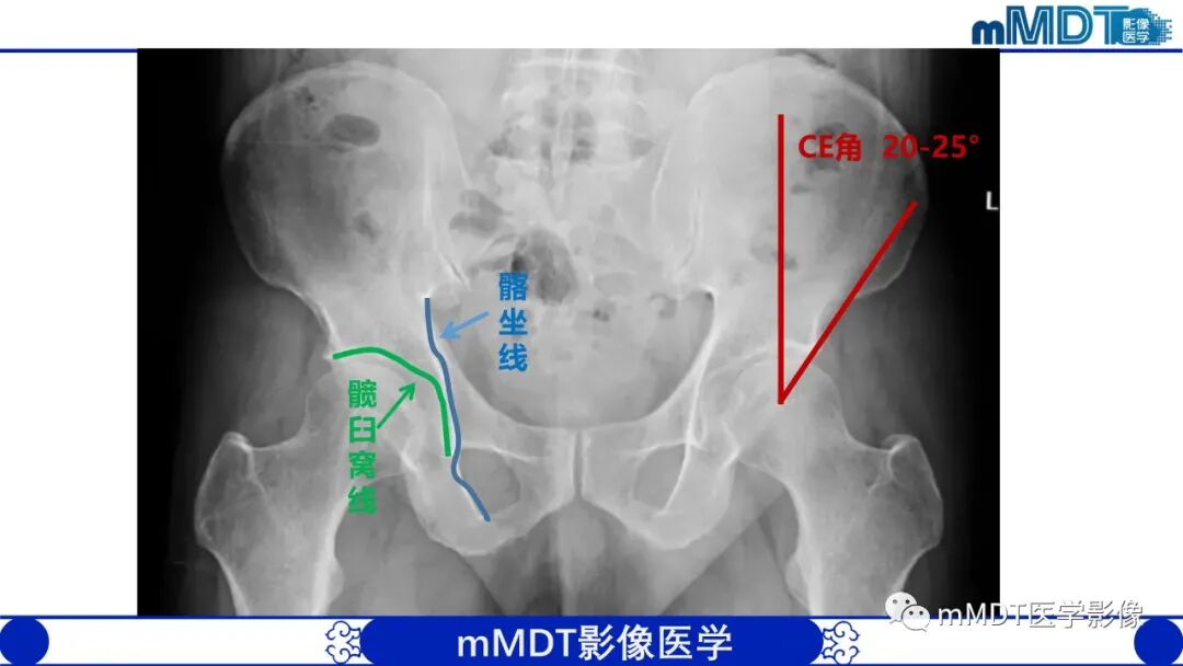 mmd在医学上什么意思髋关节疼痛临床与影像（一）_https://www.jmylbn.com_新闻资讯_第17张
