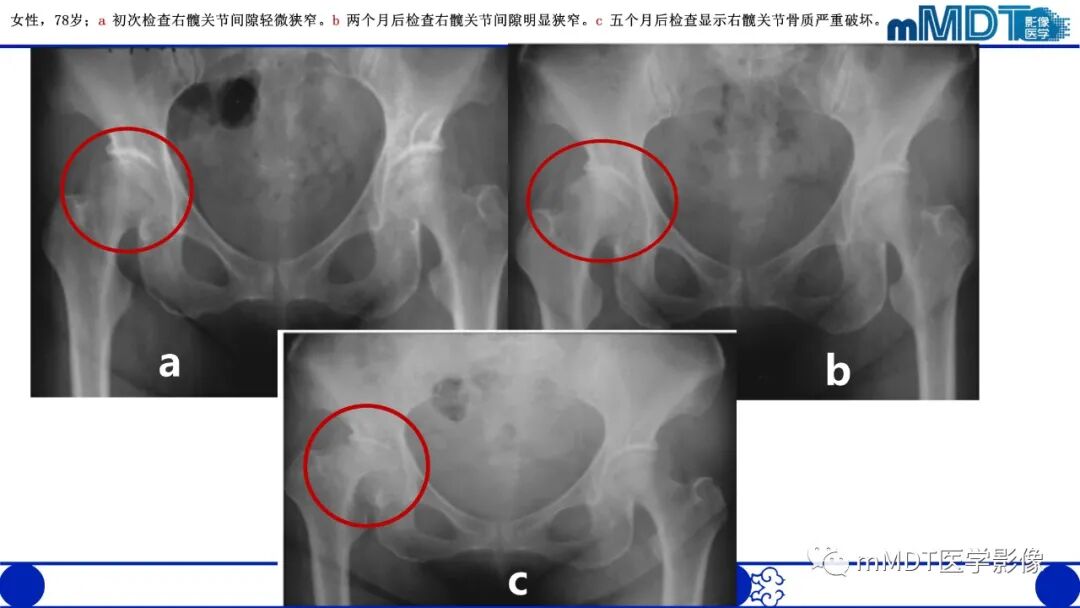 mmd在医学上什么意思髋关节疼痛临床与影像（一）_https://www.jmylbn.com_新闻资讯_第36张