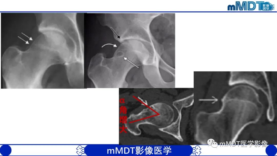 mmd在医学上什么意思髋关节疼痛临床与影像（一）_https://www.jmylbn.com_新闻资讯_第21张