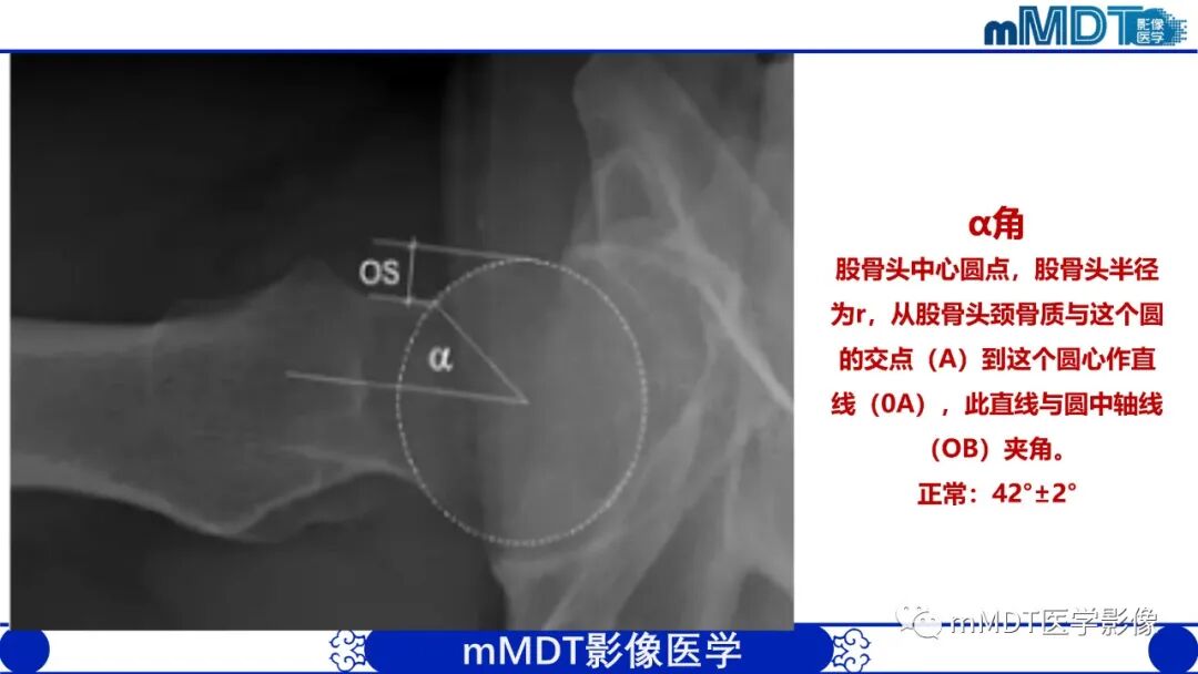 mmd在医学上什么意思髋关节疼痛临床与影像（一）_https://www.jmylbn.com_新闻资讯_第16张