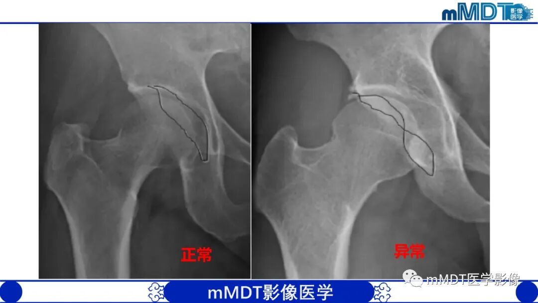 mmd在医学上什么意思髋关节疼痛临床与影像（一）_https://www.jmylbn.com_新闻资讯_第26张