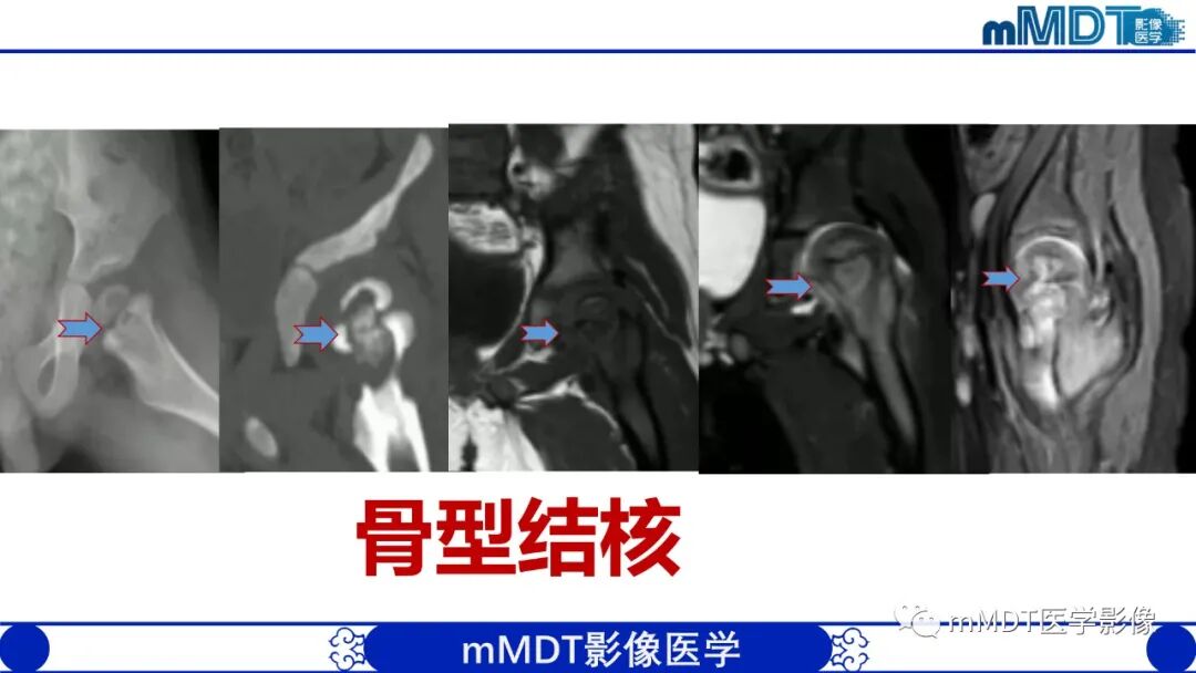 mmd在医学上什么意思髋关节疼痛临床与影像（一）_https://www.jmylbn.com_新闻资讯_第45张