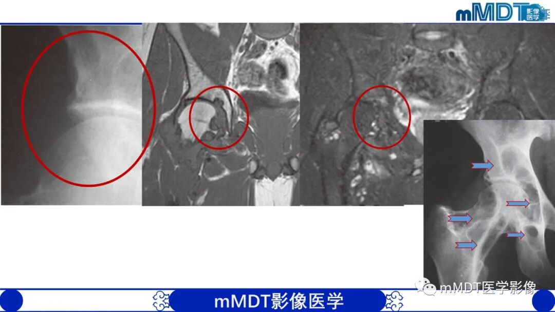 mmd在医学上什么意思髋关节疼痛临床与影像（一）_https://www.jmylbn.com_新闻资讯_第55张