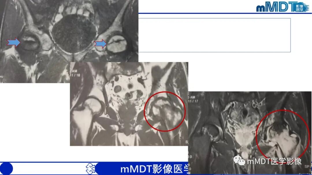 mmd在医学上什么意思髋关节疼痛临床与影像（一）_https://www.jmylbn.com_新闻资讯_第32张