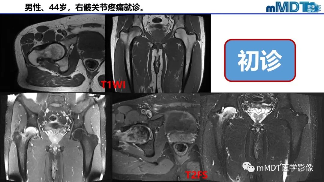 mmd在医学上什么意思髋关节疼痛临床与影像（一）_https://www.jmylbn.com_新闻资讯_第7张