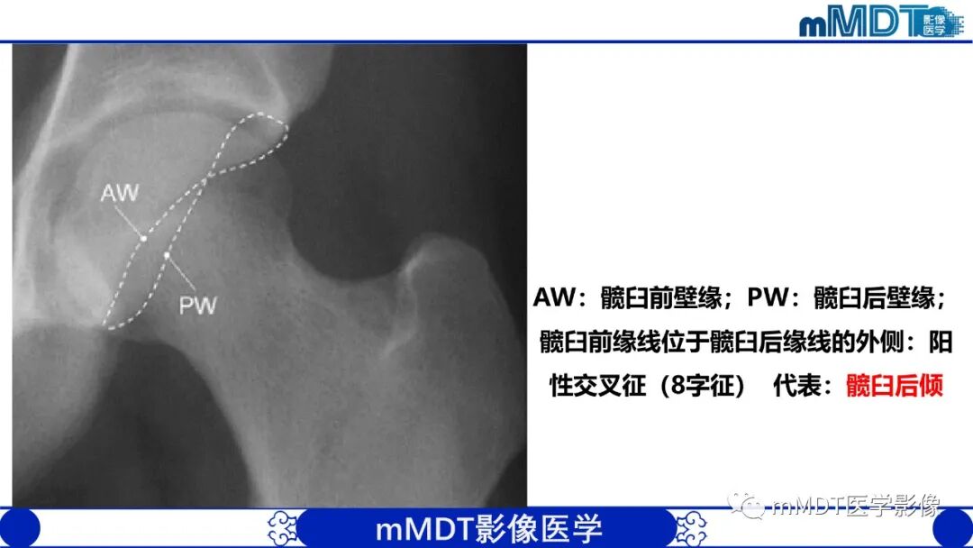 mmd在医学上什么意思髋关节疼痛临床与影像（一）_https://www.jmylbn.com_新闻资讯_第24张