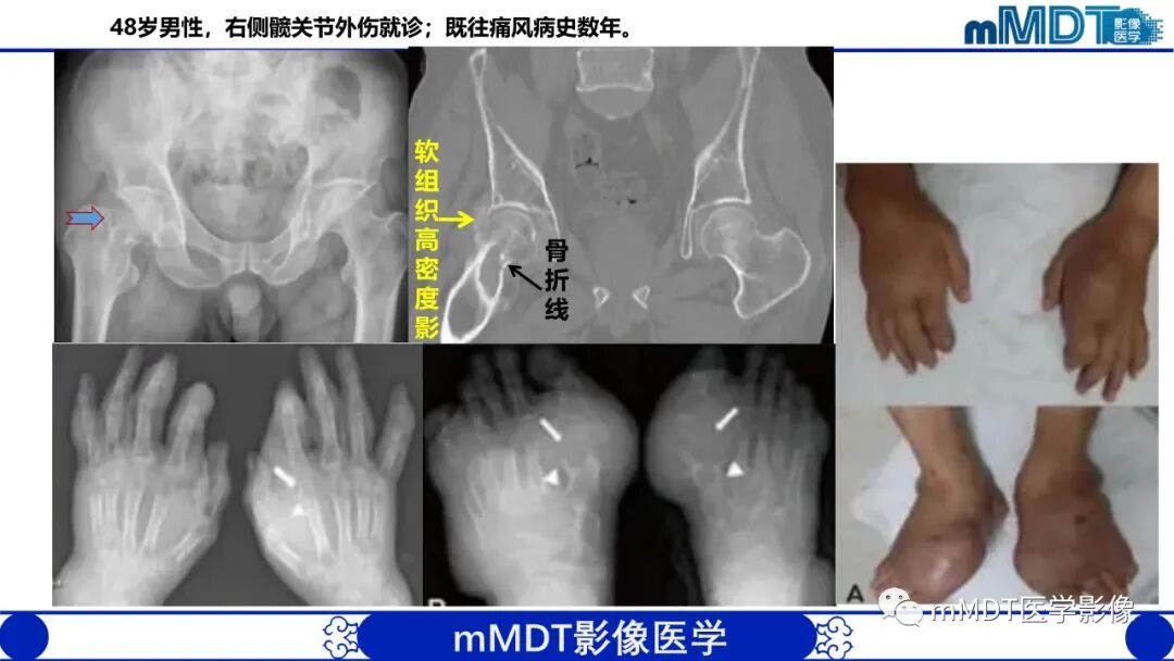 mmd在医学上什么意思髋关节疼痛临床与影像（一）_https://www.jmylbn.com_新闻资讯_第51张
