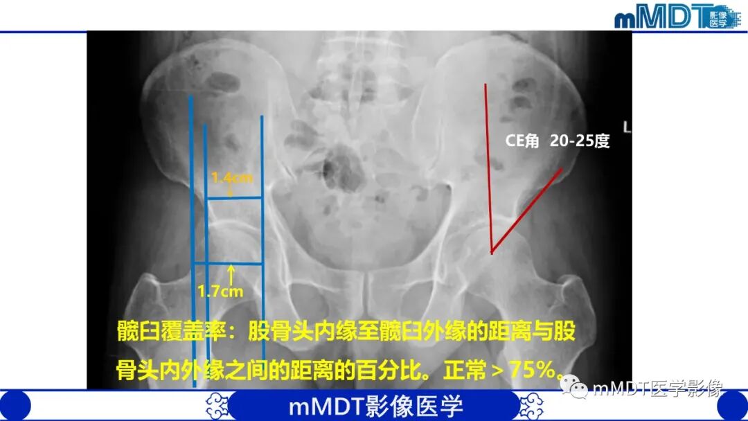 mmd在医学上什么意思髋关节疼痛临床与影像（一）_https://www.jmylbn.com_新闻资讯_第10张