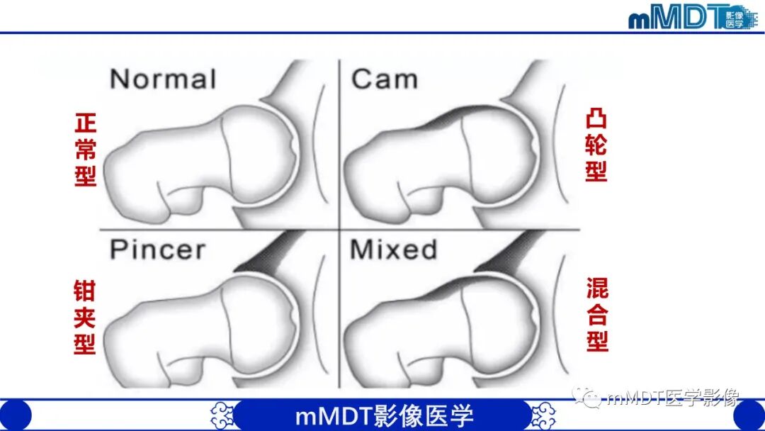 mmd在医学上什么意思髋关节疼痛临床与影像（一）_https://www.jmylbn.com_新闻资讯_第18张