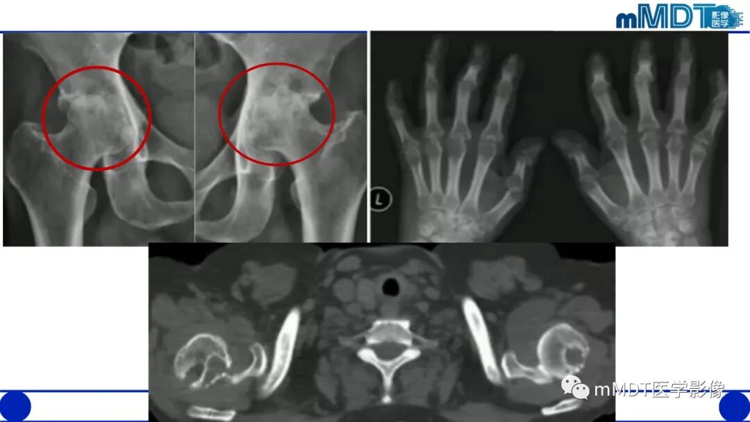 mmd在医学上什么意思髋关节疼痛临床与影像（一）_https://www.jmylbn.com_新闻资讯_第47张