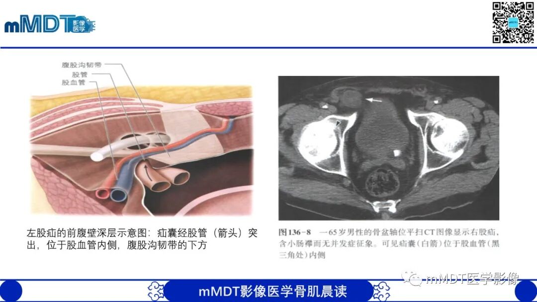 mmd在医学上什么意思常见腹外疝的影像诊断（修正版）_https://www.jmylbn.com_新闻资讯_第15张