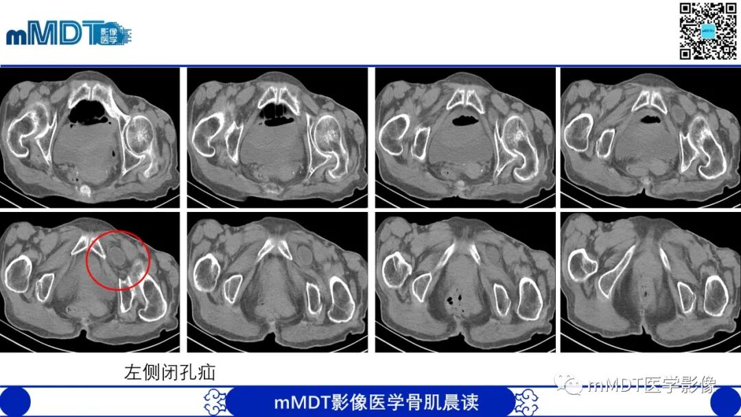 mmd在医学上什么意思常见腹外疝的影像诊断（修正版）_https://www.jmylbn.com_新闻资讯_第32张
